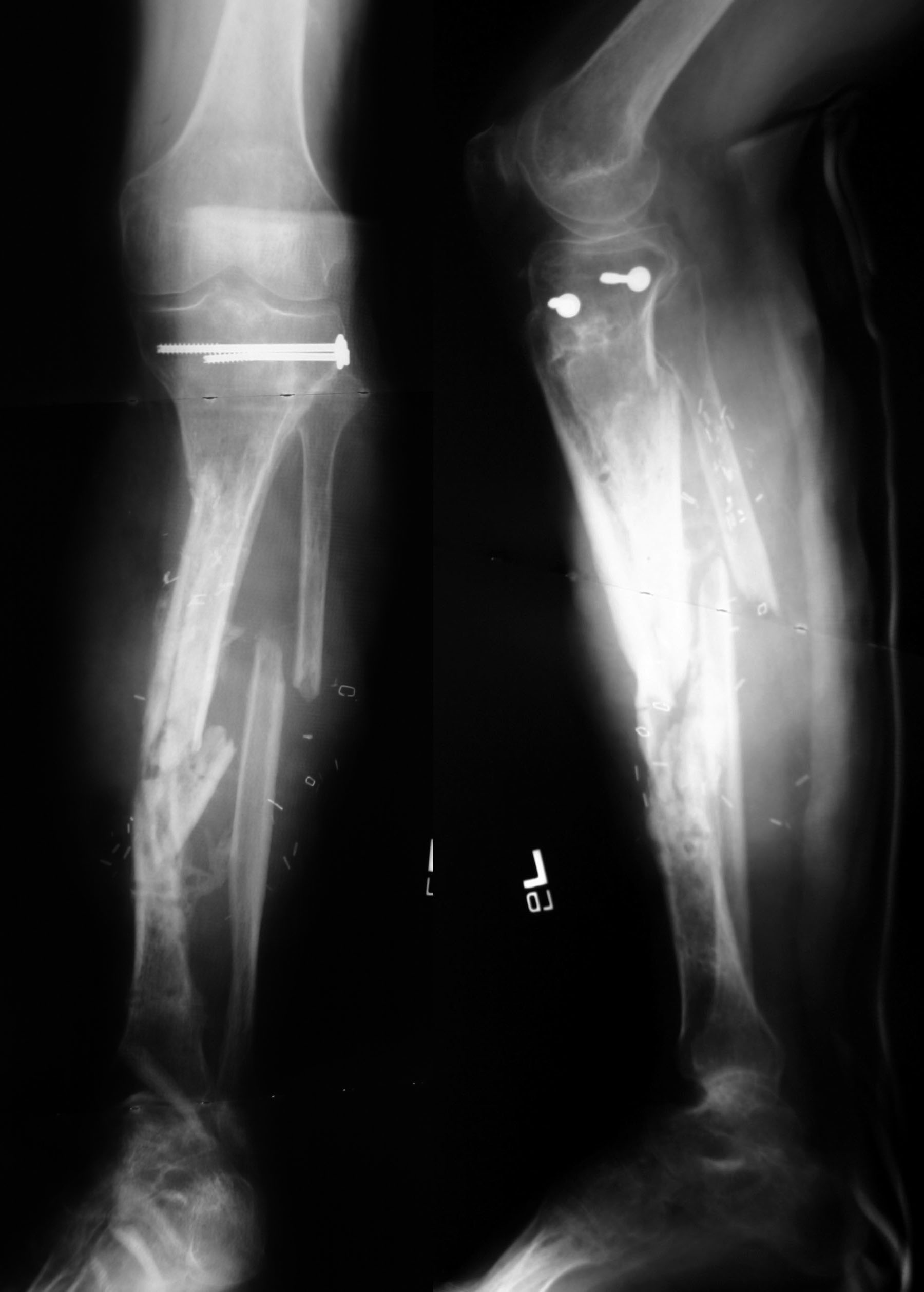 a) A 40 year old male with infected non-union left tibia type IIc of