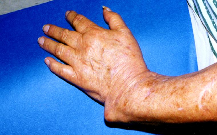 Deformities: Forearm/Wrist Case 1 - Dr. Mark Brinker, Houston