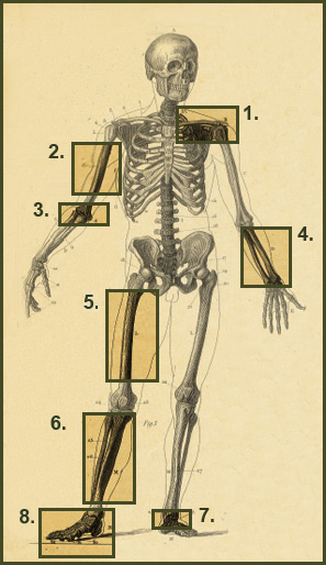 Non Union Fracture Case Studies